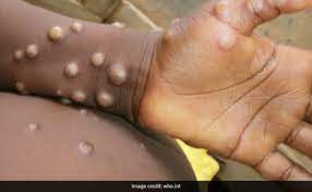 Monkeypox virus: Authorities issue advisory in J&K, urges officials to isolate suspected cases immediately