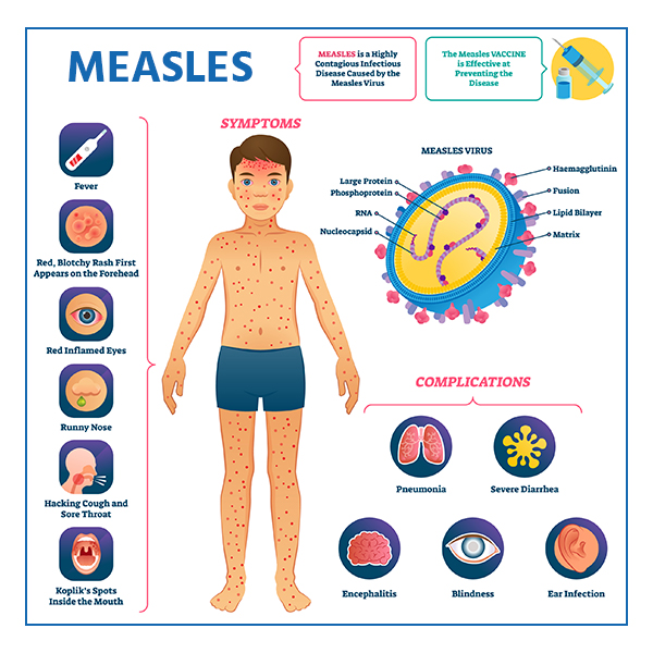 Measles virus reported in Kupwara village; CMO monitoring situation