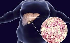 Doctors say one in 3 persons in Kashmir have fatty liver